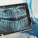 Quanto tempo dura um implante dentário?