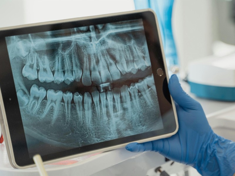 Quanto tempo dura um implante dentário?